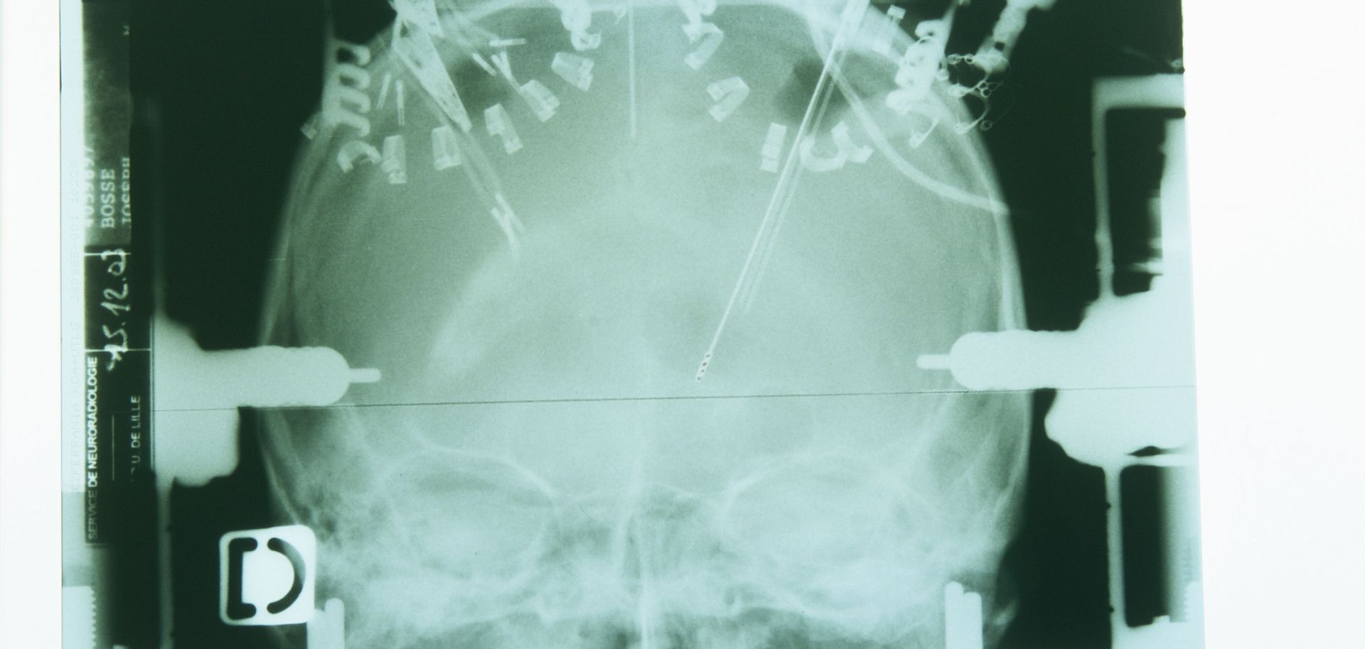 X-ray of the electrode implanted in the left hemisphere of the brain.